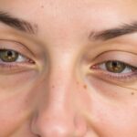 Guide complet : Comment éliminer efficacement les taches brunes sur la peau ?